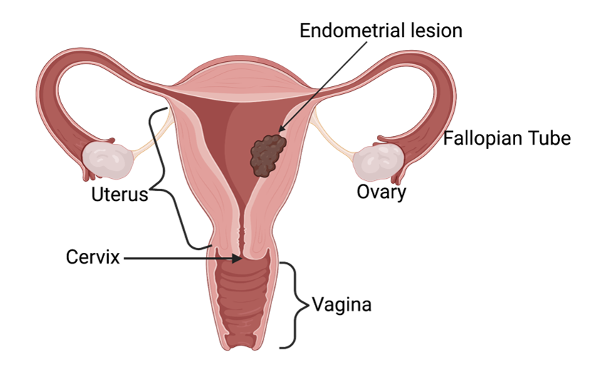 Endometrial cancer tumor in female reproductive system
